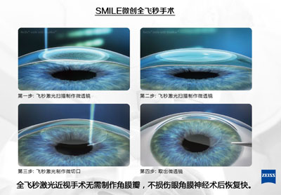 準(zhǔn)分子激光和飛秒激光的區(qū)別？