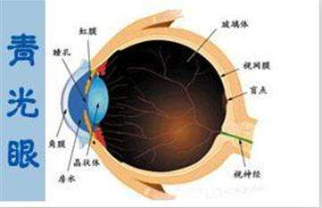 青光眼手術(shù)的費(fèi)用多少？