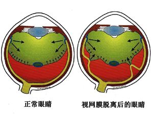 視網膜脫離的癥狀及方法